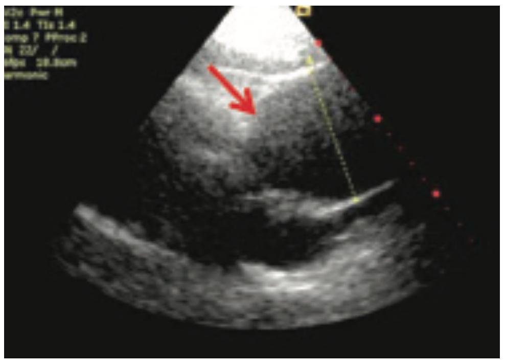 Management of an Ascending Aortic Aneurysm Diagnosed in an Outpatient Setting